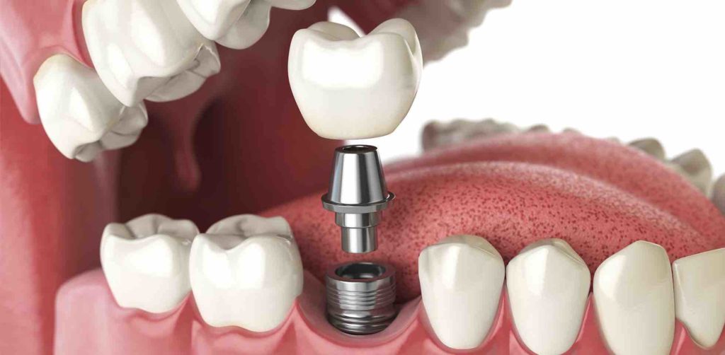 Animated Picture of Dental Implants