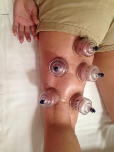 Man getting cupping therapy on his thigh