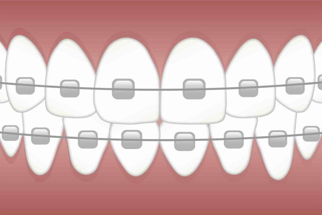 Illustration of teeth and braces