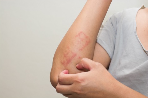 Picture of a woman with a skin rash