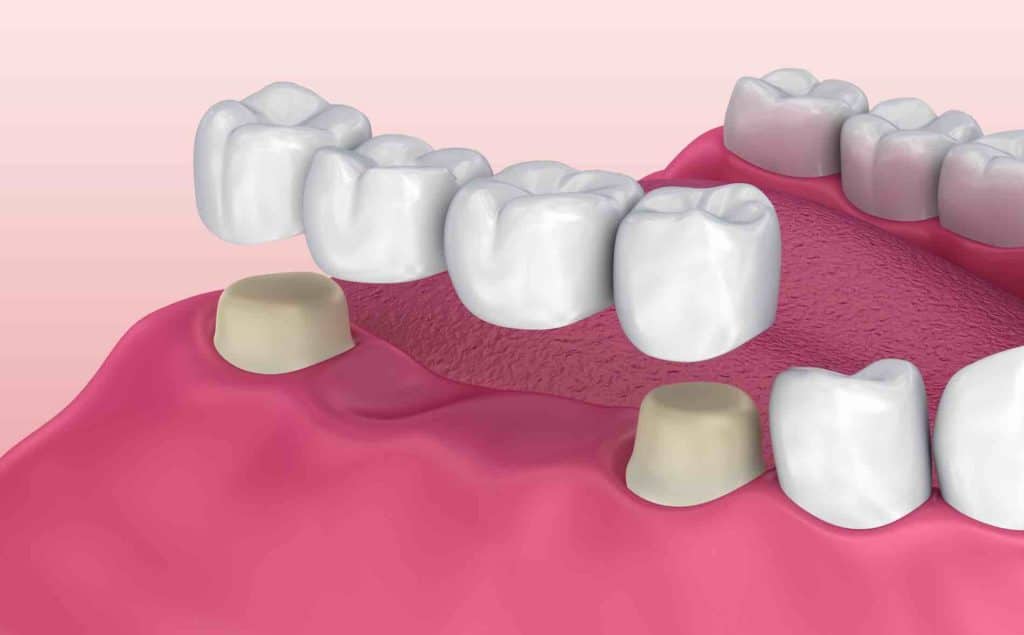 Comprehensive Guide To Dental Bridges For Lost Teeth - BiomedJ