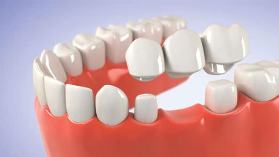 3d Model of Dental Bridge