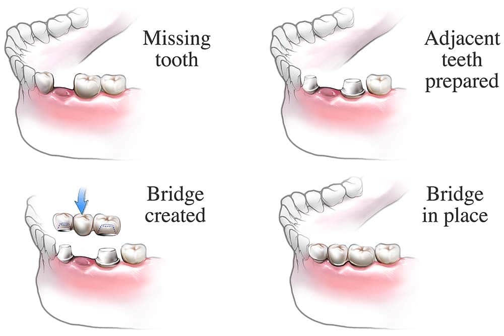 Illustrated guide to the steps in installing a dental bridge