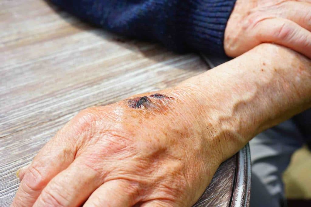 Older man's hand with a soft tissue injury