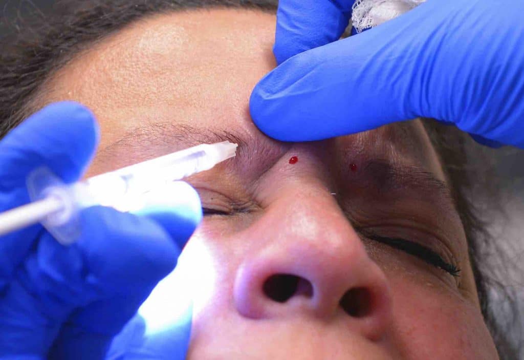 Person getting Botox injections