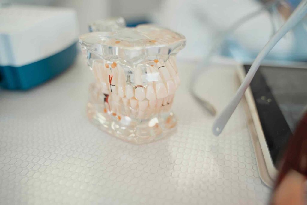Picture of a set of dental implants